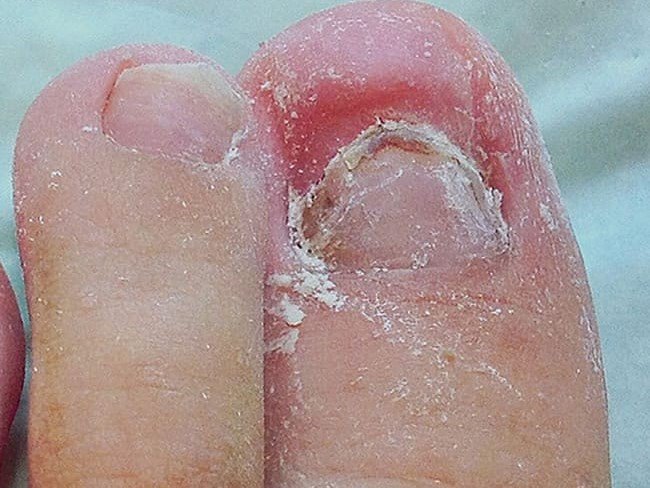 Reconstruções ungueais