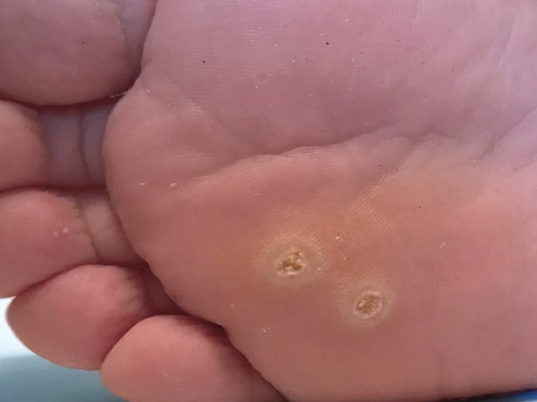 Verruga plantar